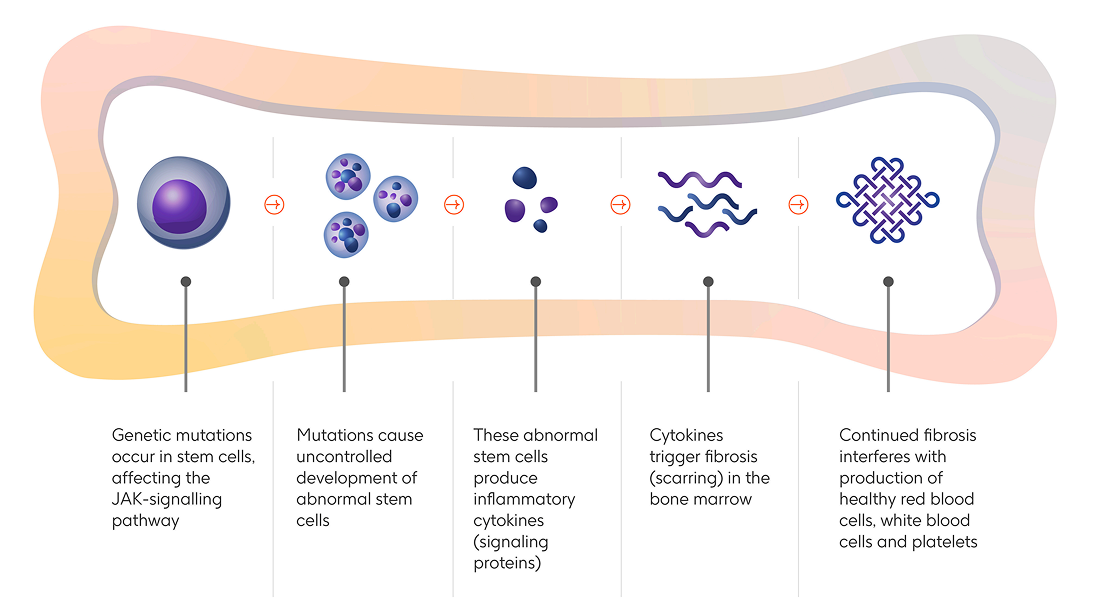 An expandable infographic explaining what myelofibrosis is.